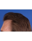 After Hair Transplant&nbsp;2 Sessions (Areas)